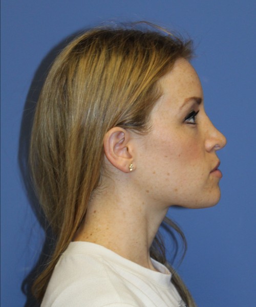Rhinoplasty 1594 – Click HERE for more views after photo. Individual results may vary.