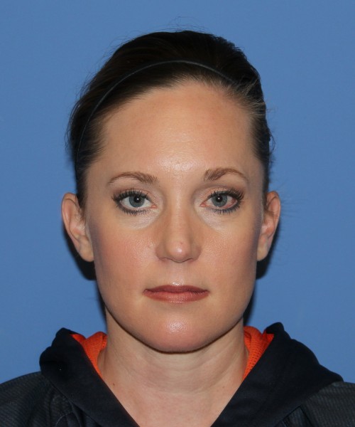 Rhinoplasty, Submental Liposuction with Thermi 1595 – Click HERE for more views after photo. Individual results may vary.