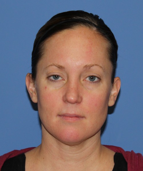 Rhinoplasty, Submental Liposuction with Thermi 1595 – Click HERE for more views before photo. Individual results may vary.