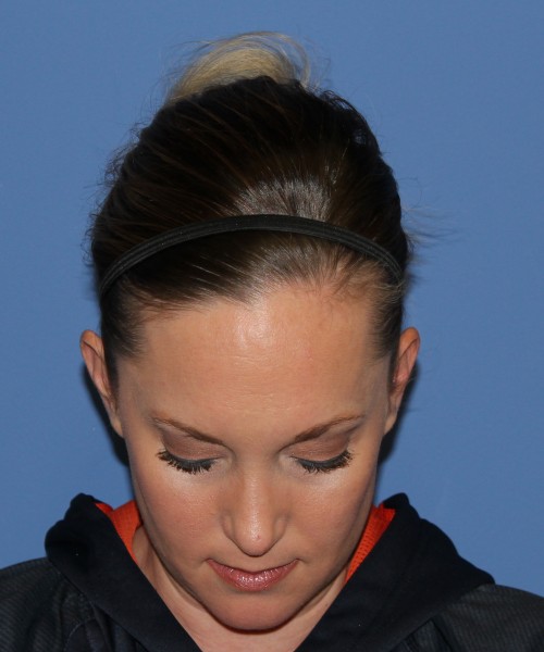 Rhinoplasty, Submental Liposuction with Thermi 1595 – Click HERE for more views after photo. Individual results may vary.