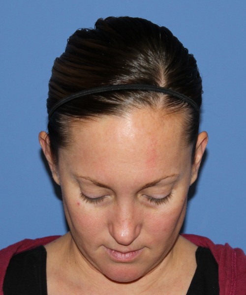 Rhinoplasty, Submental Liposuction with Thermi 1595 – Click HERE for more views before photo. Individual results may vary.