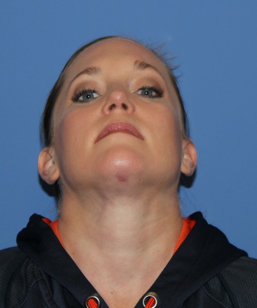 Rhinoplasty, Submental Liposuction with Thermi 1595 – Click HERE for more views after photo. Individual results may vary.