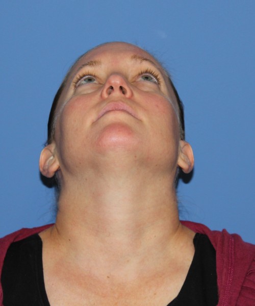 Rhinoplasty, Submental Liposuction with Thermi 1595 – Click HERE for more views before photo. Individual results may vary.