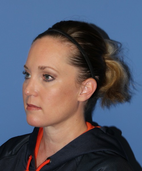 Rhinoplasty, Submental Liposuction with Thermi 1595 – Click HERE for more views after photo. Individual results may vary.