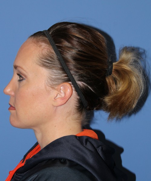 Rhinoplasty, Submental Liposuction with Thermi 1595 – Click HERE for more views after photo. Individual results may vary.