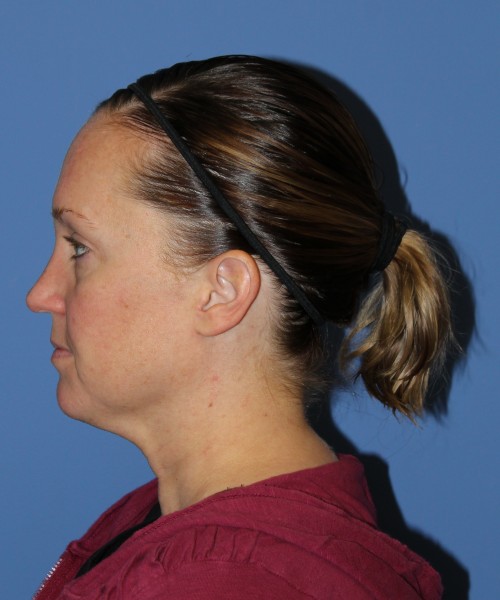 Rhinoplasty, Submental Liposuction with Thermi 1595 – Click HERE for more views before photo. Individual results may vary.