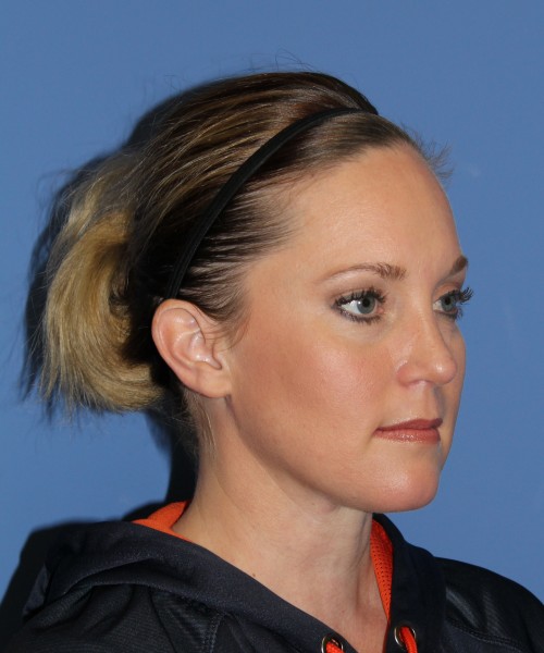 Rhinoplasty, Submental Liposuction with Thermi 1595 – Click HERE for more views after photo. Individual results may vary.