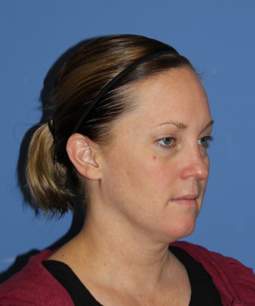 Rhinoplasty, Submental Liposuction with Thermi 1595 – Click HERE for more views before photo. Individual results may vary.
