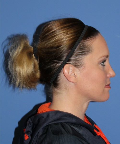 Rhinoplasty, Submental Liposuction with Thermi 1595 – Click HERE for more views after photo. Individual results may vary.