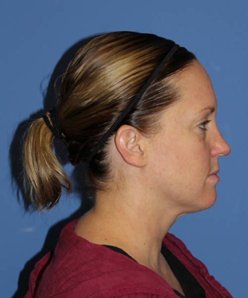 Rhinoplasty, Submental Liposuction with Thermi 1595 – Click HERE for more views before photo. Individual results may vary.
