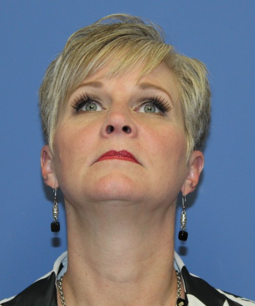 Rhinoplasty 1596 – Click HERE for more views after photo. Individual results may vary.