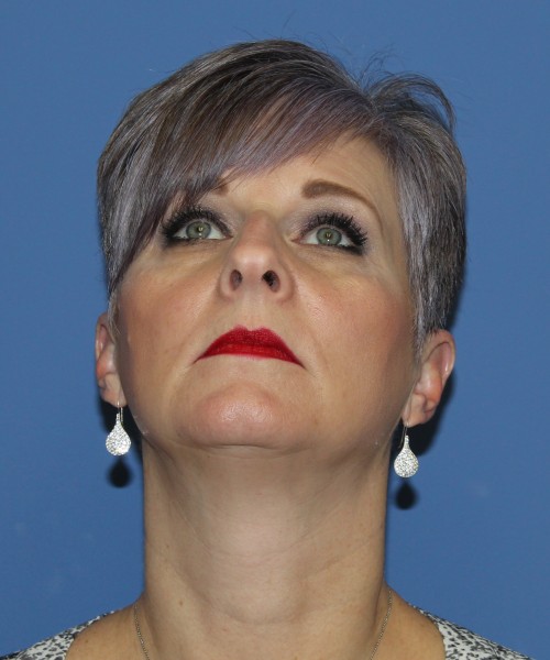 Rhinoplasty 1596 – Click HERE for more views before photo. Individual results may vary.