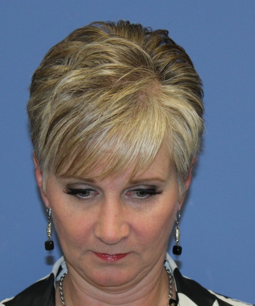 Rhinoplasty 1596 – Click HERE for more views after photo. Individual results may vary.