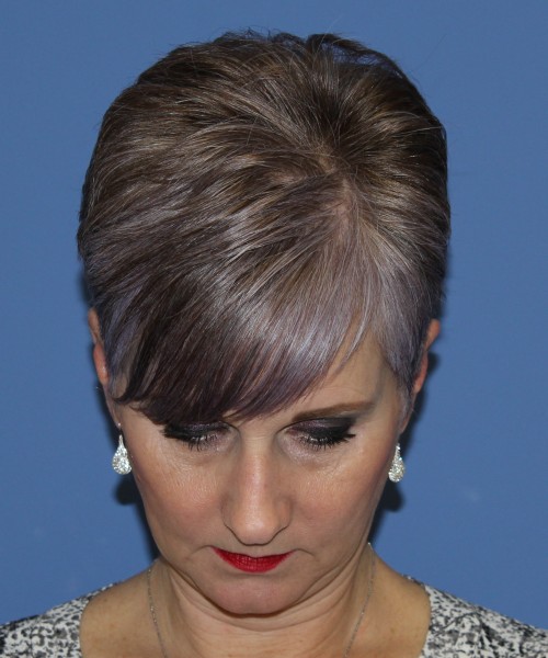Rhinoplasty 1596 – Click HERE for more views before photo. Individual results may vary.