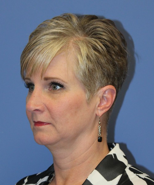 Rhinoplasty 1596 – Click HERE for more views after photo. Individual results may vary.