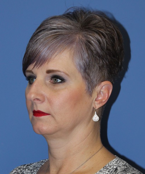 Rhinoplasty 1596 – Click HERE for more views before photo. Individual results may vary.