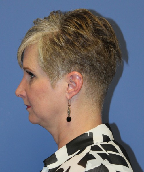 Rhinoplasty 1596 – Click HERE for more views after photo. Individual results may vary.
