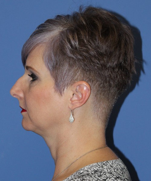 Rhinoplasty 1596 – Click HERE for more views before photo. Individual results may vary.