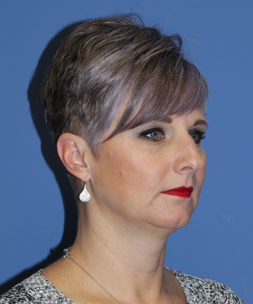 Rhinoplasty 1596 – Click HERE for more views before photo. Individual results may vary.