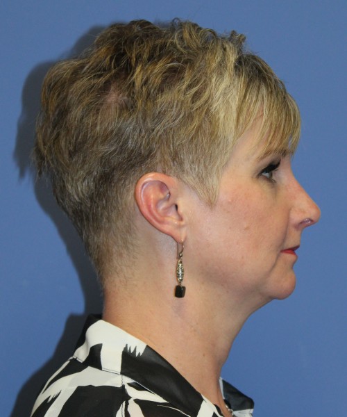 Rhinoplasty 1596 – Click HERE for more views after photo. Individual results may vary.