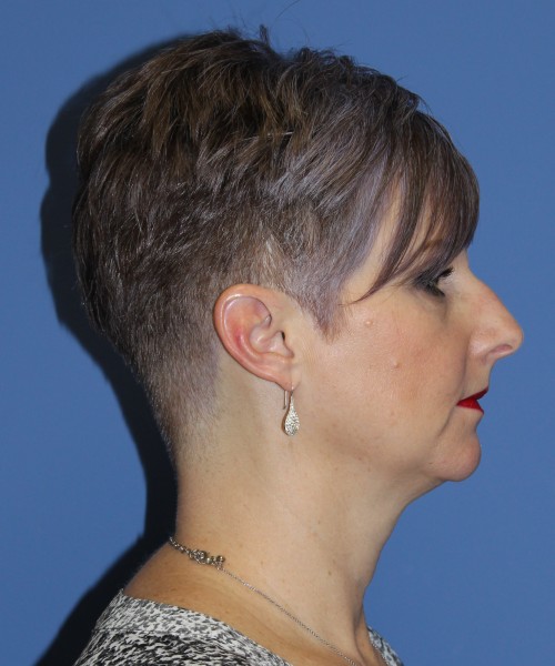 Rhinoplasty 1596 – Click HERE for more views before photo. Individual results may vary.