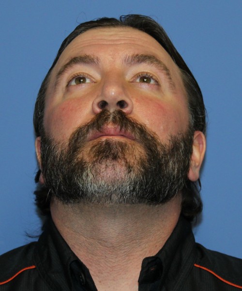 Rhinoplasty 1597 – Click HERE for more views after photo. Individual results may vary.