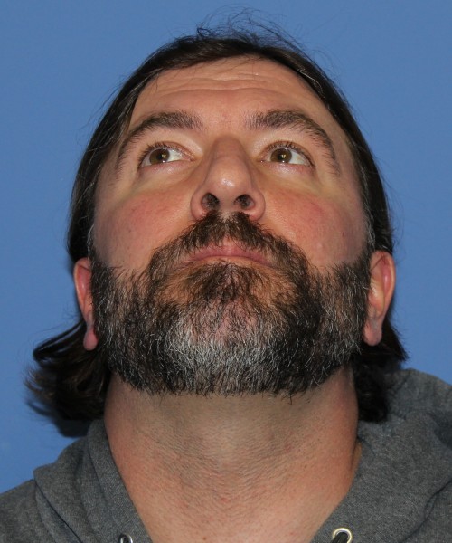 Rhinoplasty 1597 – Click HERE for more views before photo. Individual results may vary.