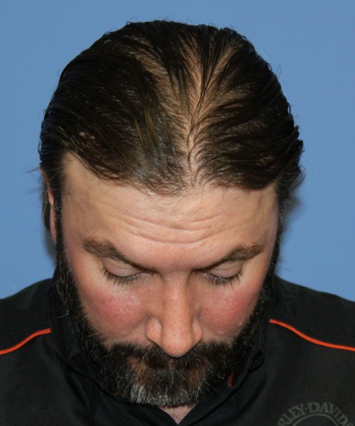 Rhinoplasty 1597 – Click HERE for more views after photo. Individual results may vary.