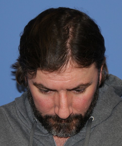 Rhinoplasty 1597 – Click HERE for more views before photo. Individual results may vary.