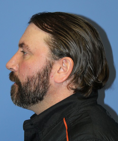 Rhinoplasty 1597 – Click HERE for more views after photo. Individual results may vary.