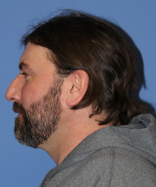 Rhinoplasty 1597 – Click HERE for more views before photo. Individual results may vary.