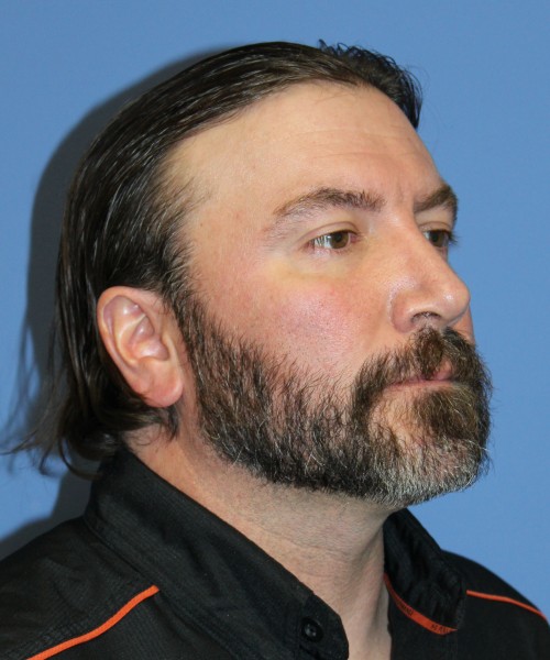 Rhinoplasty 1597 – Click HERE for more views after photo. Individual results may vary.