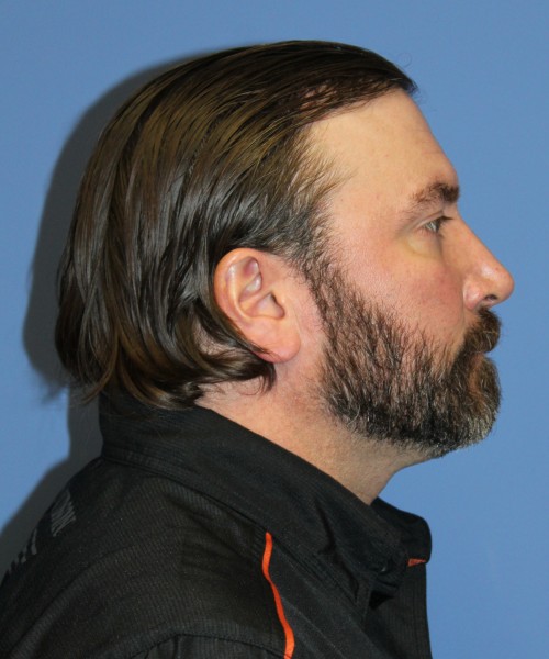 Rhinoplasty 1597 – Click HERE for more views after photo. Individual results may vary.