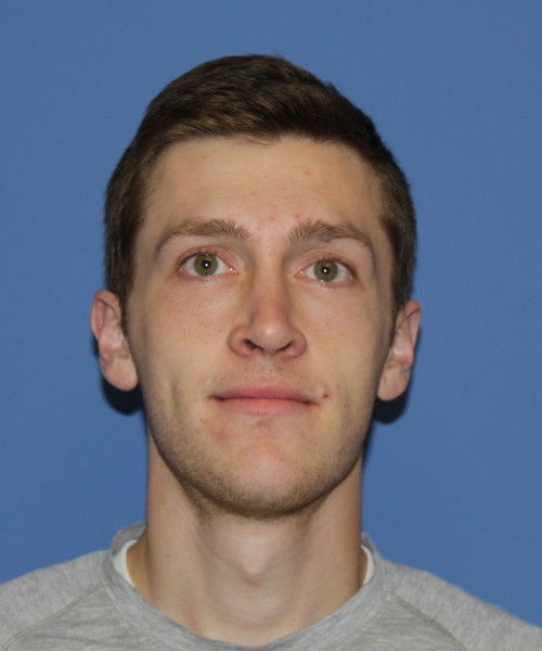 Rhinoplasty 1750 – Click HERE for more views after photo. Individual results may vary.