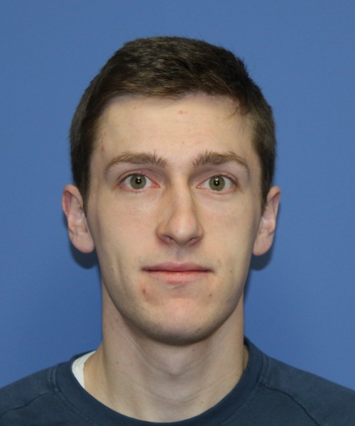 Rhinoplasty 1750 – Click HERE for more views before photo. Individual results may vary.