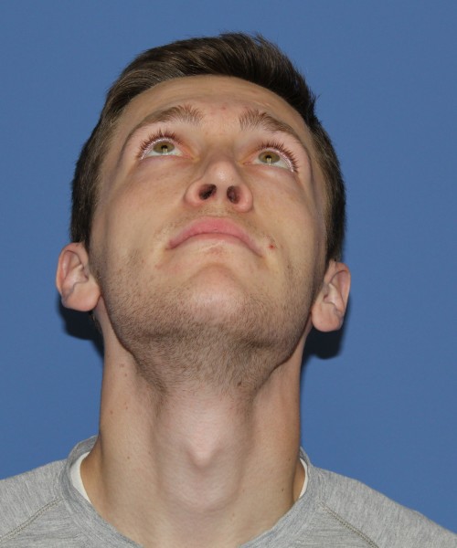 Rhinoplasty 1750 – Click HERE for more views after photo. Individual results may vary.