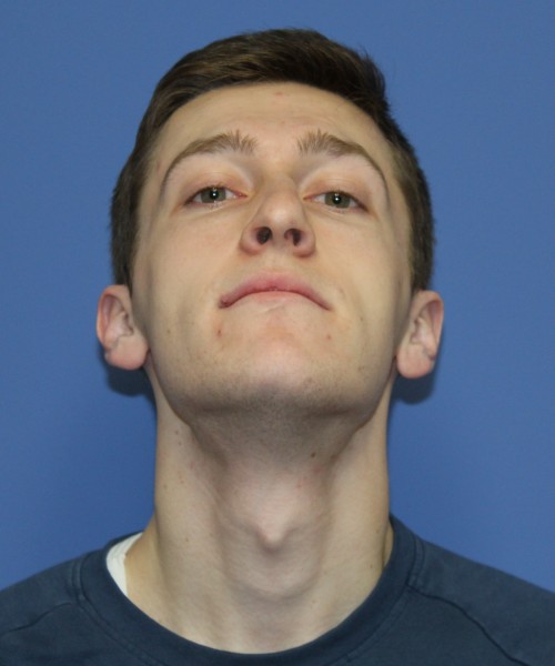Rhinoplasty 1750 – Click HERE for more views before photo. Individual results may vary.