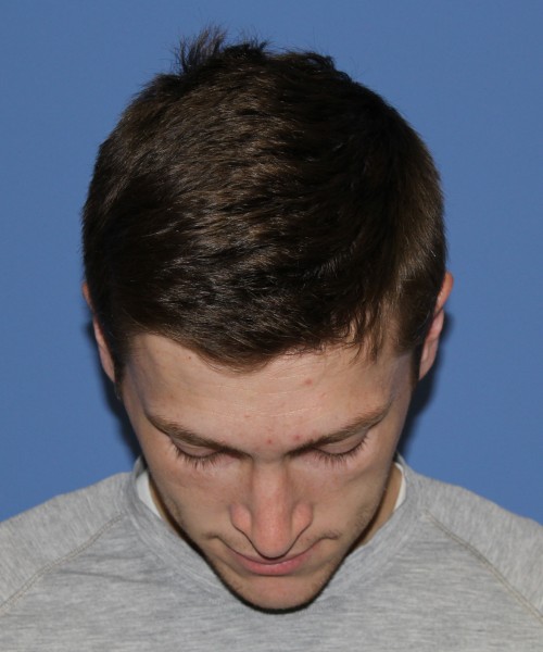 Rhinoplasty 1750 – Click HERE for more views after photo. Individual results may vary.