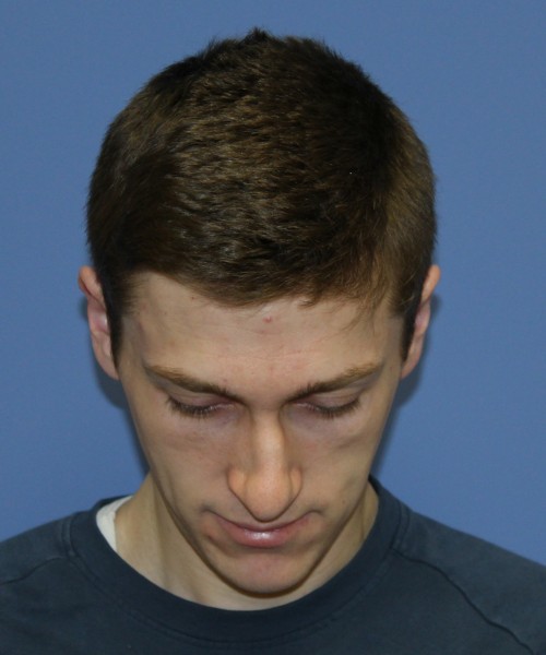 Rhinoplasty 1750 – Click HERE for more views before photo. Individual results may vary.