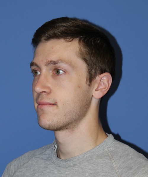 Rhinoplasty 1750 – Click HERE for more views after photo. Individual results may vary.