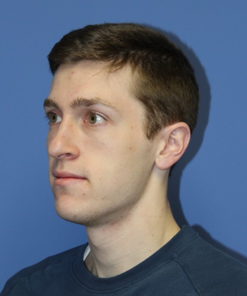 Rhinoplasty 1750 – Click HERE for more views before photo. Individual results may vary.