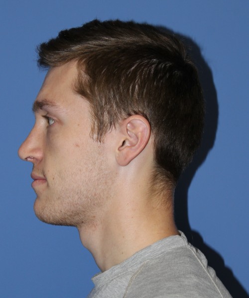 Rhinoplasty 1750 – Click HERE for more views after photo. Individual results may vary.