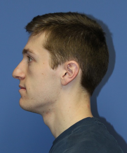 Rhinoplasty 1750 – Click HERE for more views before photo. Individual results may vary.