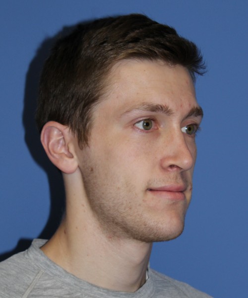 Rhinoplasty 1750 – Click HERE for more views after photo. Individual results may vary.