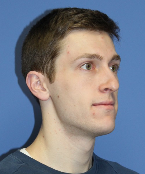 Rhinoplasty 1750 – Click HERE for more views before photo. Individual results may vary.