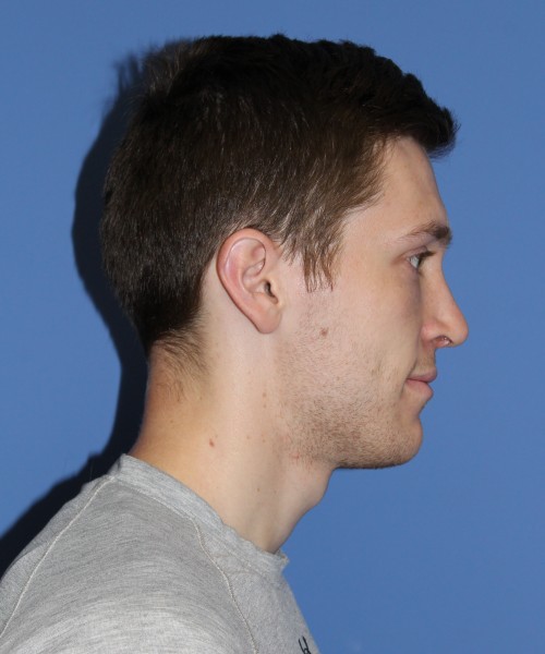 Rhinoplasty 1750 – Click HERE for more views after photo. Individual results may vary.