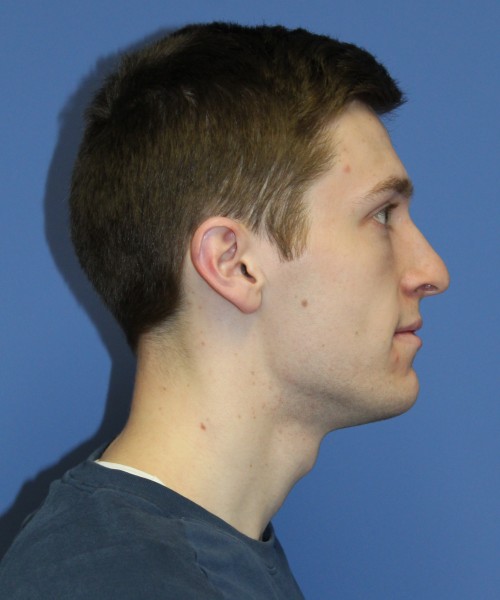 Rhinoplasty 1750 – Click HERE for more views before photo. Individual results may vary.