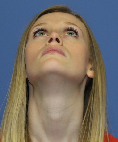 Rhinoplasty 1751 – Click HERE for more views after photo. Individual results may vary.