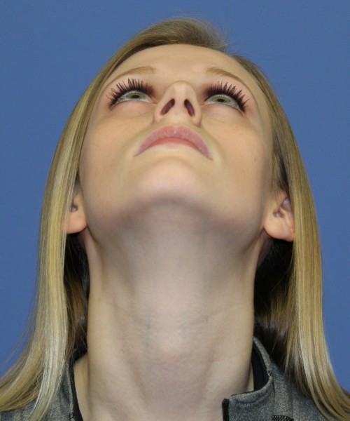Rhinoplasty 1751 – Click HERE for more views before photo. Individual results may vary.