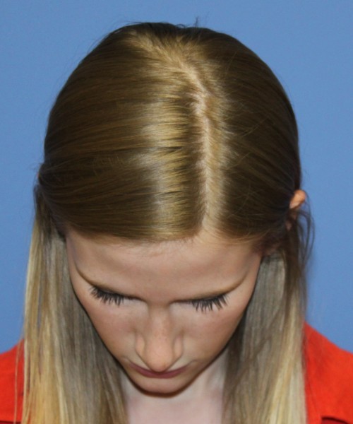 Rhinoplasty 1751 – Click HERE for more views after photo. Individual results may vary.